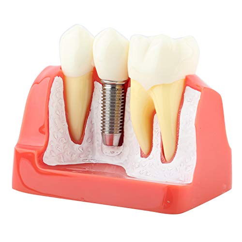 Modelo de dente, 1pc Resina Demonstração dental Modelo de dente Análise de implante Crown Bridge