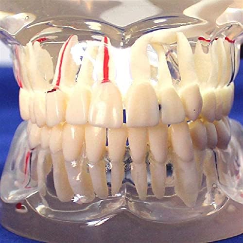 Modelo de ensino, modelo de dentes de doenças dentárias - modelo de implante de dentes dentários - modelo transparente