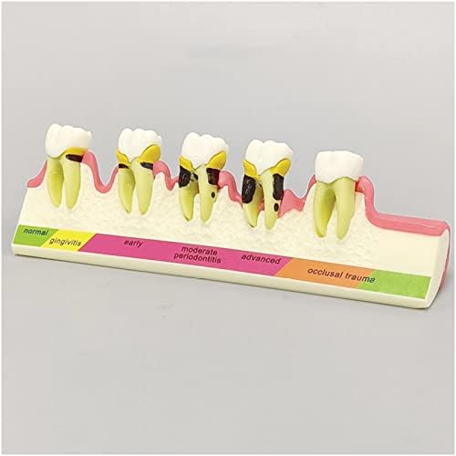 Modelo de Classificação de Doenças Periodontais KH66ZKY, Modelo de Demonstração Dental de dentes, para Modelo de Exibição de Comunicação Paciente Patiental